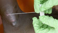 Worm Cases Guinea Eradication Program South Sudan