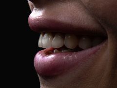 Teeth Primates Lesions Fossil Abfraction Tooth